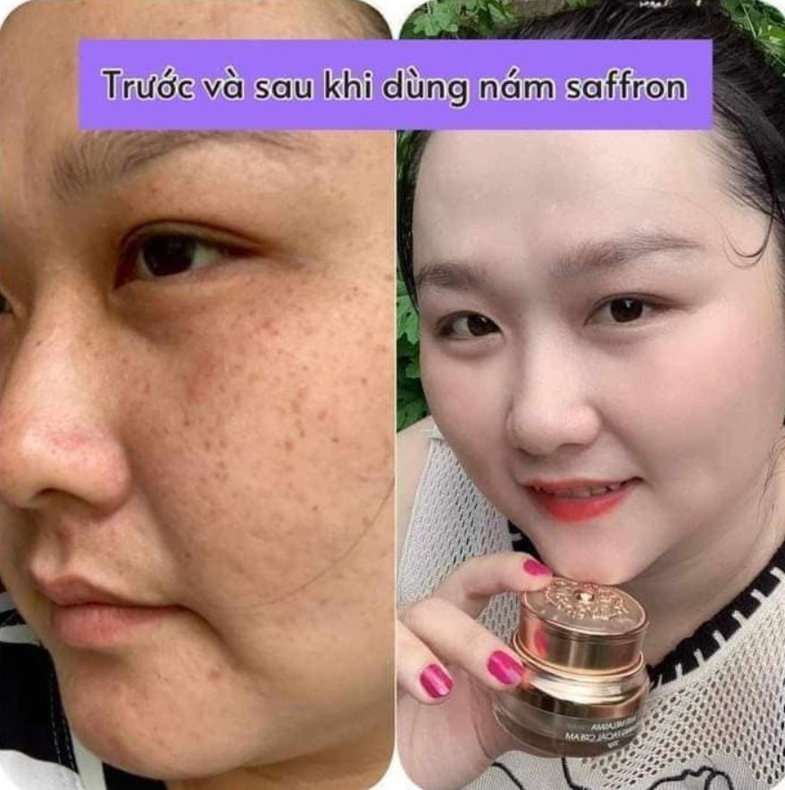 Hình ảnh trước và sau sử dụng Kem nám Saffron Hải Âu Việt giảm thâm nám