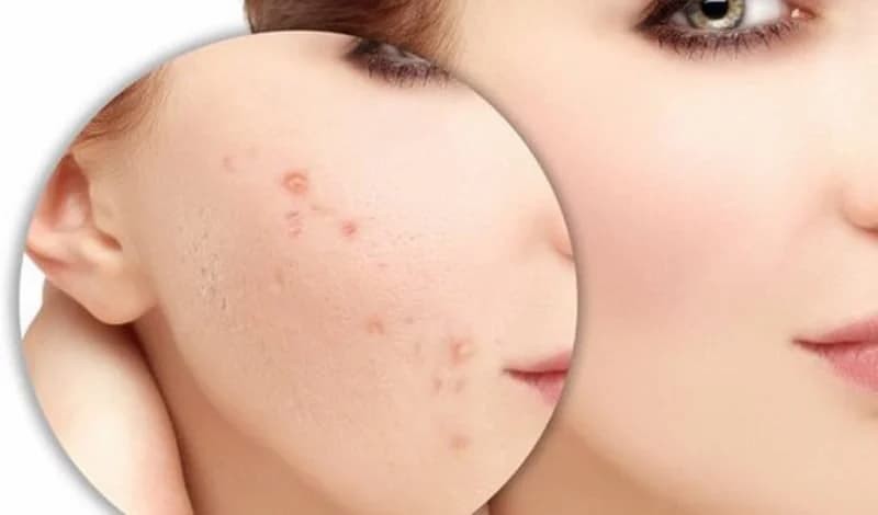 Công nghệ Cell Layer phục hồi da yếu sau nhiễm corticoid có hiệu quả?