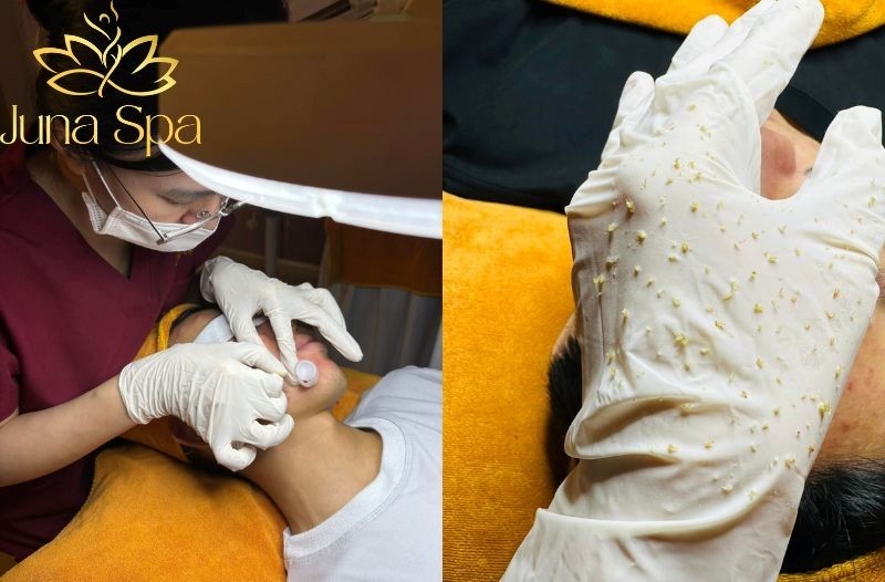 Công nghệ Cell Layer phục hồi da yếu sau nhiễm corticoid có hiệu quả?